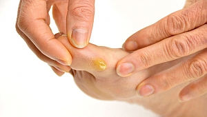 Ayaklarda Oluşan Nasırlardan Kurtulun