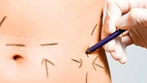 Yağ alma (Liposuction) nedir?
