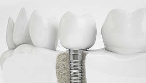 İmplant diş fiyatları ne kadar?