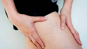 Varis Hastalığı Riskli Bir Hastalıktır