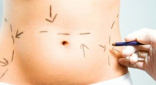 Liposuction ve Yağ aldırma 