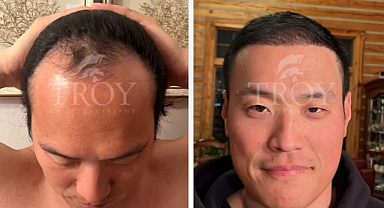 Hair Transplant CostTurkey