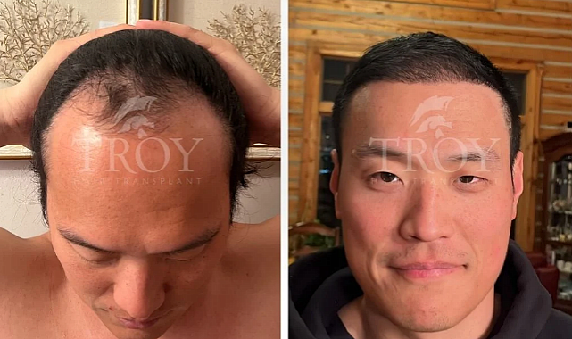Hair Transplant CostTurkey