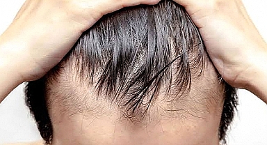 Hair Transplant Antalya – Haarex Clinic